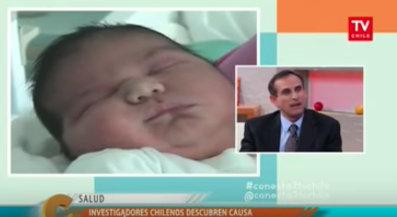 Recién Nacidos sobre 4 kgs  son macrosómicos, dice ginecólogo UC/ Dr. Claudio Vera, Conectados.