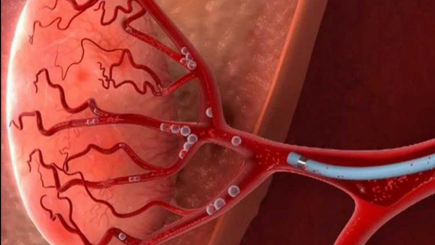 Novedoso tratamiento para miomas: Embolización de arterias uterinas